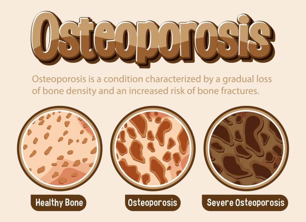 Stages of Osteoporosis